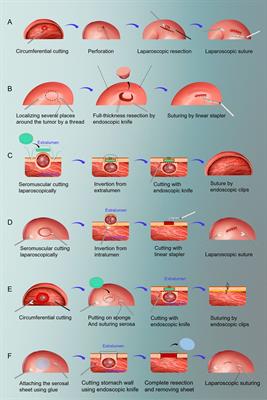 Frontiers | Laparoscopic And Endoscopic Cooperative Surgery For Early ...